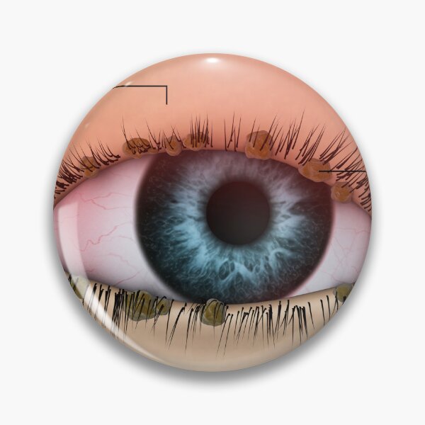 Item preview, STK701345H-Blepharitis in the human eye. designed and sold by StocktrekImages.