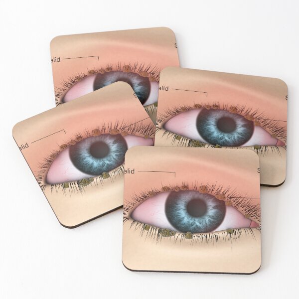 Item preview, STK701345H-Blepharitis in the human eye. designed and sold by StocktrekImages.