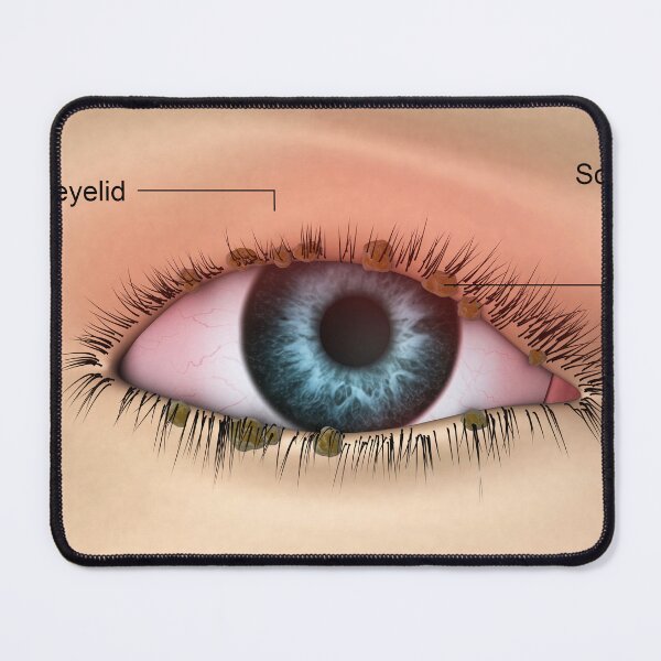 Item preview, STK701345H-Blepharitis in the human eye. designed and sold by StocktrekImages.