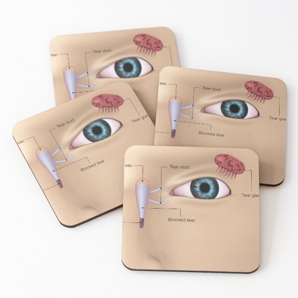 Item preview, STK701346H-Vlocked tear ducts in the human eye. designed and sold by StocktrekImages.