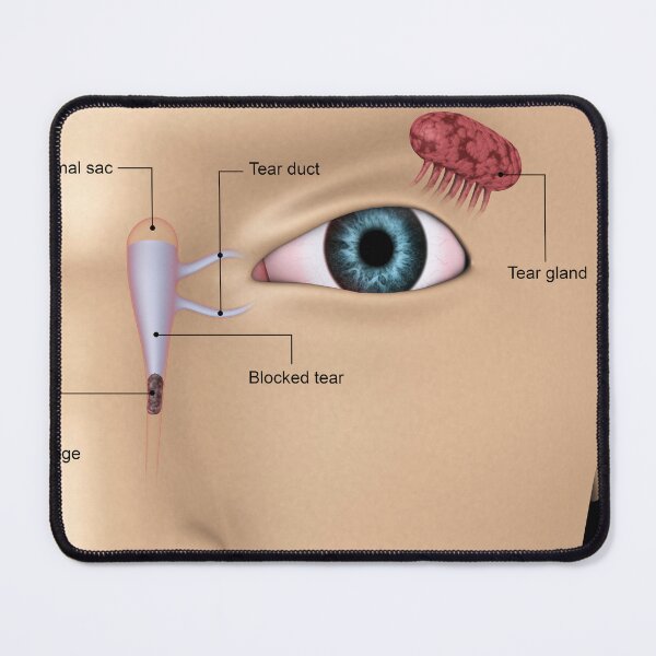 Item preview, STK701346H-Vlocked tear ducts in the human eye. designed and sold by StocktrekImages.
