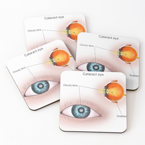Item preview, STK701347H-Cataract in the human eye. designed and sold by StocktrekImages.