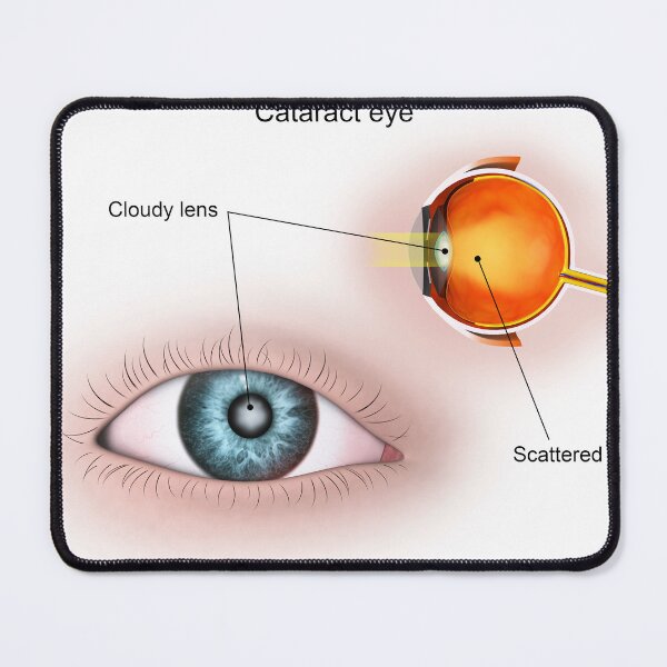 Item preview, STK701347H-Cataract in the human eye. designed and sold by StocktrekImages.