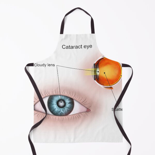 Item preview, STK701347H-Cataract in the human eye. designed and sold by StocktrekImages.