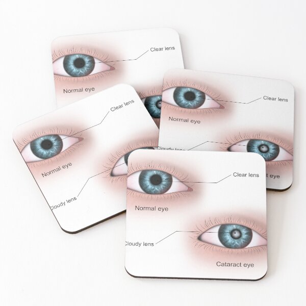 Item preview, STK701348H-Cataract in the human eye compared to a normal eye. designed and sold by StocktrekImages.