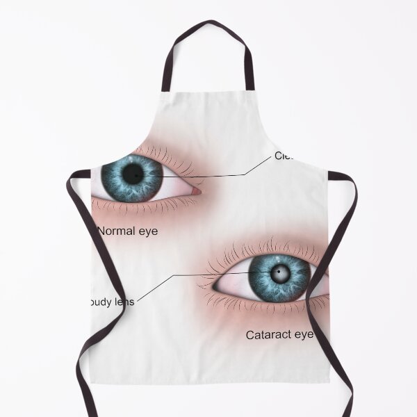 Item preview, STK701348H-Cataract in the human eye compared to a normal eye. designed and sold by StocktrekImages.