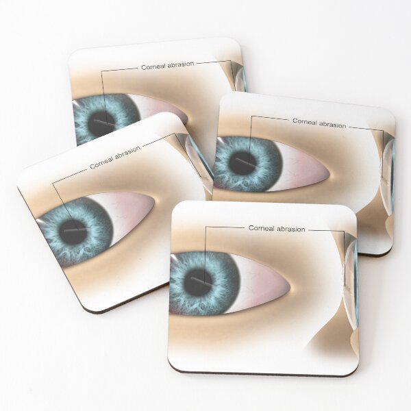 Item preview, STK701349H-Corneal abrasion in the human eye. designed and sold by StocktrekImages.