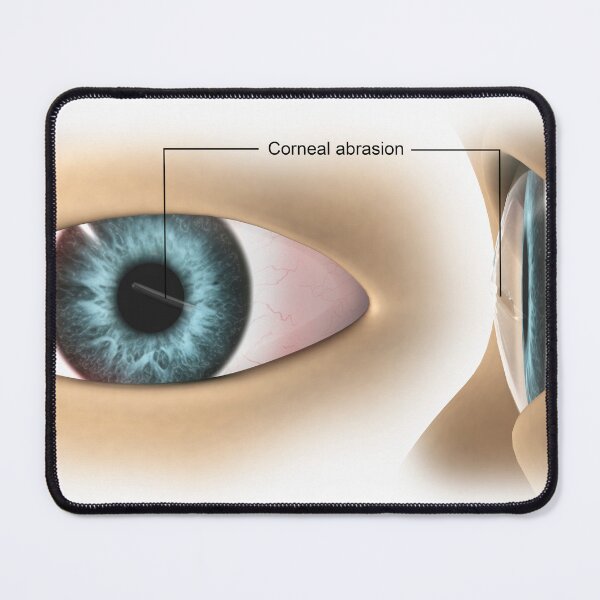 Item preview, STK701349H-Corneal abrasion in the human eye. designed and sold by StocktrekImages.