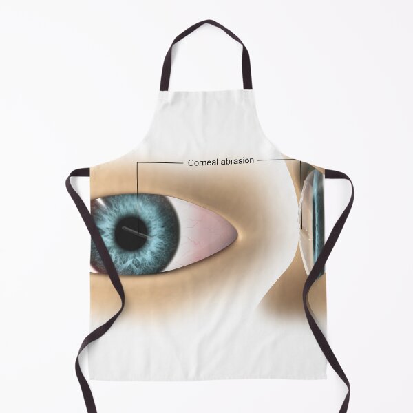 Item preview, STK701349H-Corneal abrasion in the human eye. designed and sold by StocktrekImages.