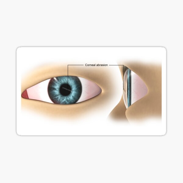 Item preview, STK701349H-Corneal abrasion in the human eye. designed and sold by StocktrekImages.