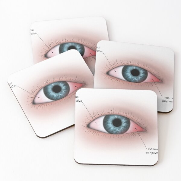 Item preview, STK701350H-Conjunctivitis in the human eye. designed and sold by StocktrekImages.
