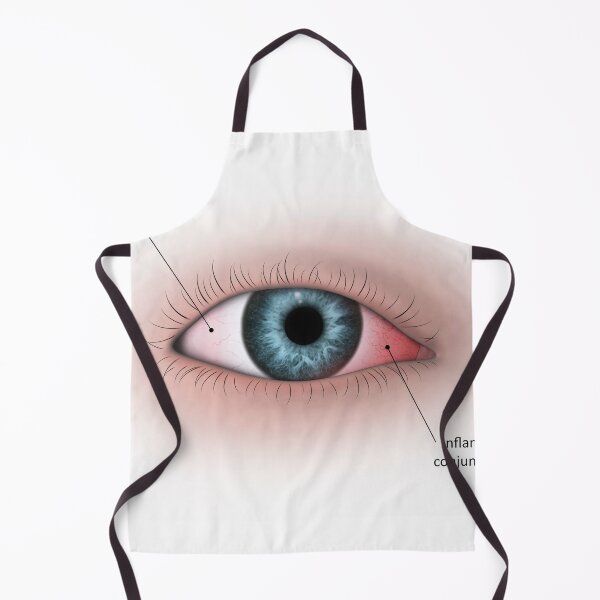Item preview, STK701350H-Conjunctivitis in the human eye. designed and sold by StocktrekImages.