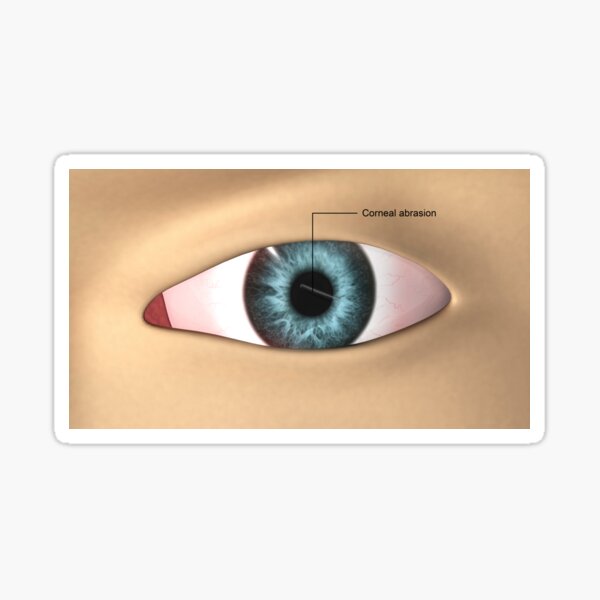 Item preview, STK701351H-Corneal abrasion in the human eye. designed and sold by StocktrekImages.