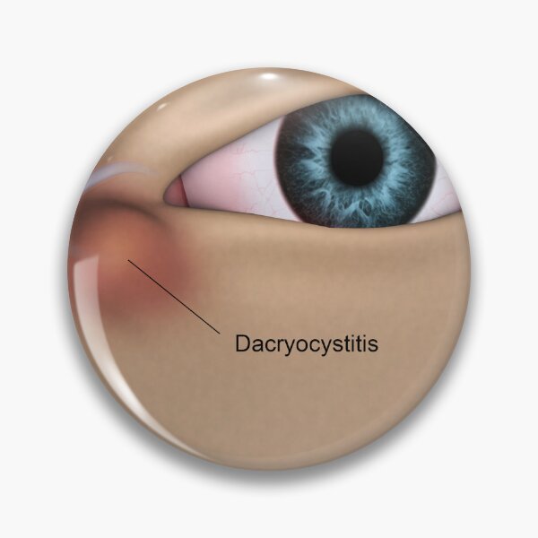 Item preview, STK701352H-Dacryocystitis in the human eye. designed and sold by StocktrekImages.