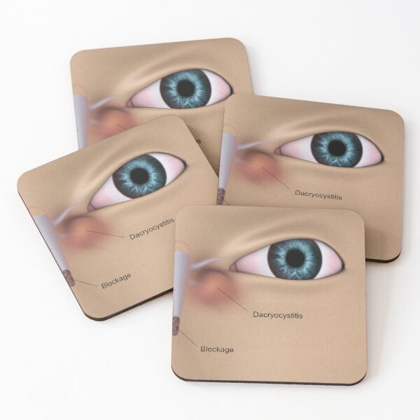 Item preview, STK701352H-Dacryocystitis in the human eye. designed and sold by StocktrekImages.