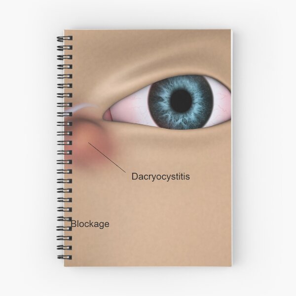 Item preview, STK701352H-Dacryocystitis in the human eye. designed and sold by StocktrekImages.