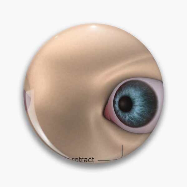 Item preview, STK701354H-Exophthalmos, bulging of the eyes. designed and sold by StocktrekImages.