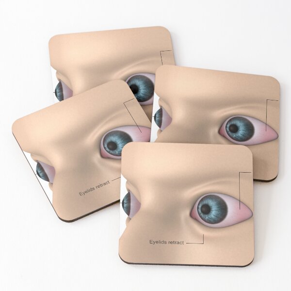 Item preview, STK701354H-Exophthalmos, bulging of the eyes. designed and sold by StocktrekImages.