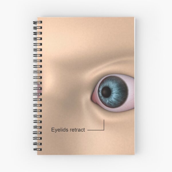 Item preview, STK701354H-Exophthalmos, bulging of the eyes. designed and sold by StocktrekImages.