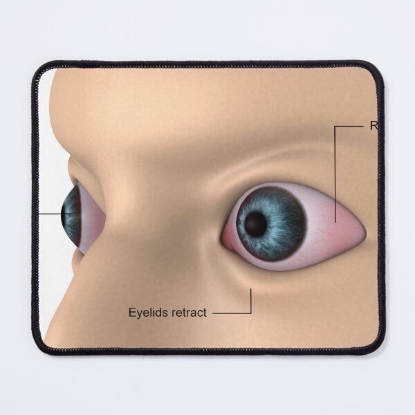 Item preview, STK701354H-Exophthalmos, bulging of the eyes. designed and sold by StocktrekImages.