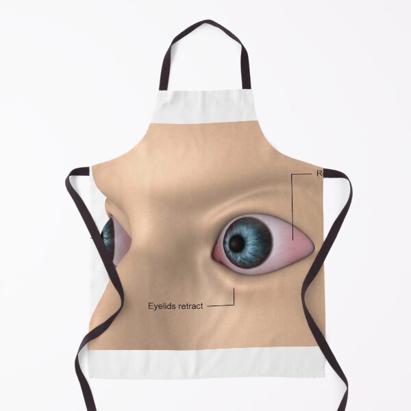 Item preview, STK701354H-Exophthalmos, bulging of the eyes. designed and sold by StocktrekImages.