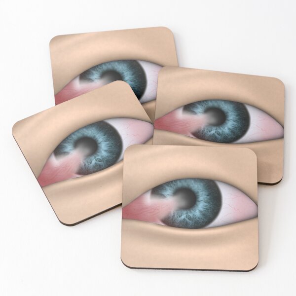 Item preview, STK701356H-Pterygium in the human eye. designed and sold by StocktrekImages.