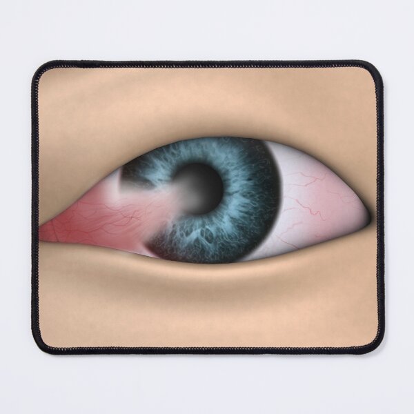 Item preview, STK701356H-Pterygium in the human eye. designed and sold by StocktrekImages.