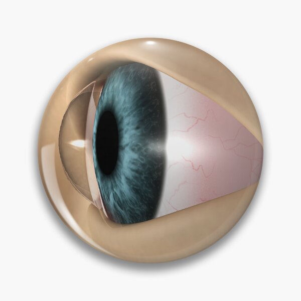 Item preview, STK701358H-Keratoconus in the eye. designed and sold by StocktrekImages.