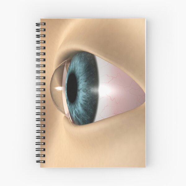 Item preview, STK701358H-Keratoconus in the eye. designed and sold by StocktrekImages.