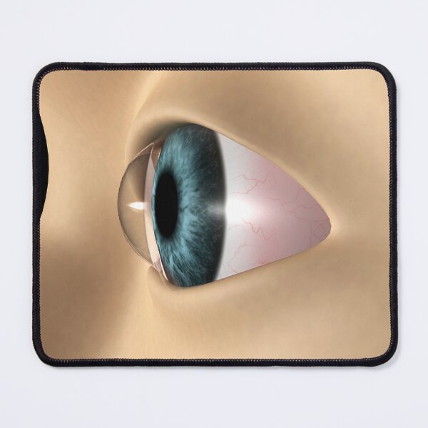 Item preview, STK701358H-Keratoconus in the eye. designed and sold by StocktrekImages.