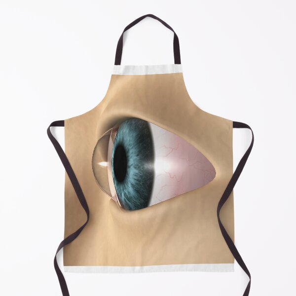 Item preview, STK701358H-Keratoconus in the eye. designed and sold by StocktrekImages.