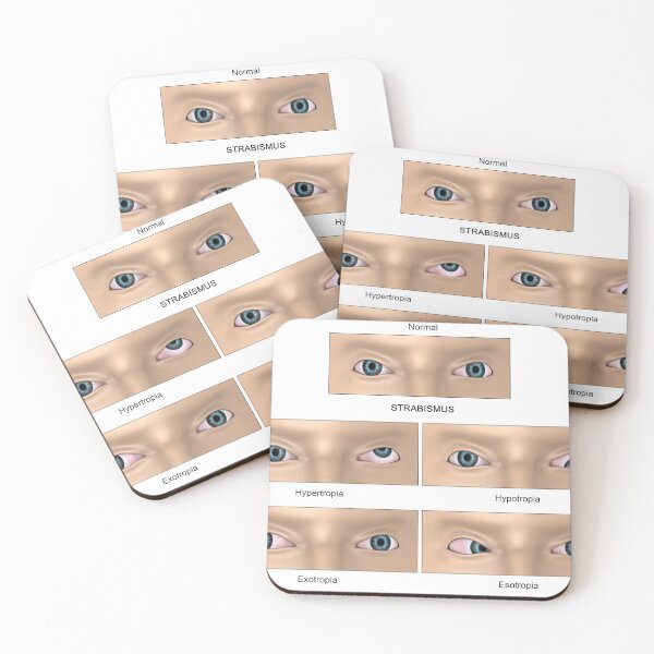 Item preview, STK701359H-Strabismus diagram. designed and sold by StocktrekImages.