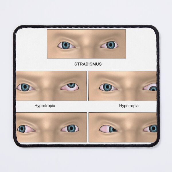 Item preview, STK701359H-Strabismus diagram. designed and sold by StocktrekImages.
