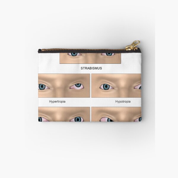 Item preview, STK701359H-Strabismus diagram. designed and sold by StocktrekImages.