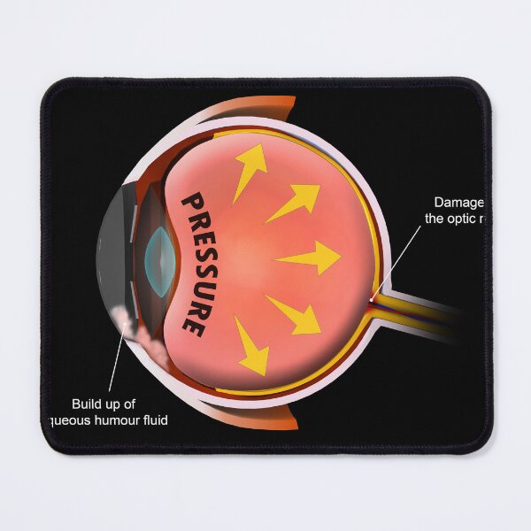 Item preview, STK701360H-Increased pressure in the eyeball leading to glaucoma. designed and sold by StocktrekImages.