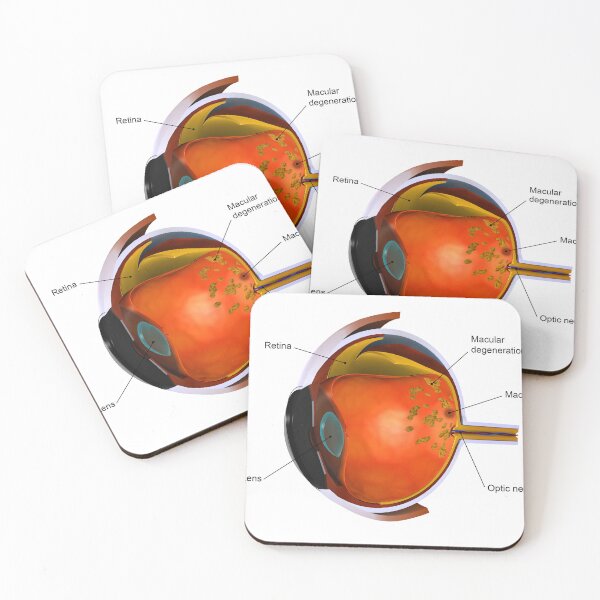 Item preview, STK701361H-Macular degeneration. designed and sold by StocktrekImages.