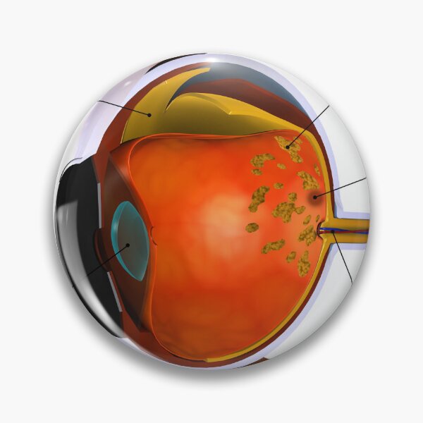 Item preview, STK701361H-Macular degeneration. designed and sold by StocktrekImages.