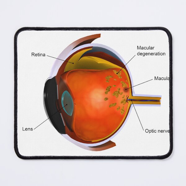 Item preview, STK701361H-Macular degeneration. designed and sold by StocktrekImages.