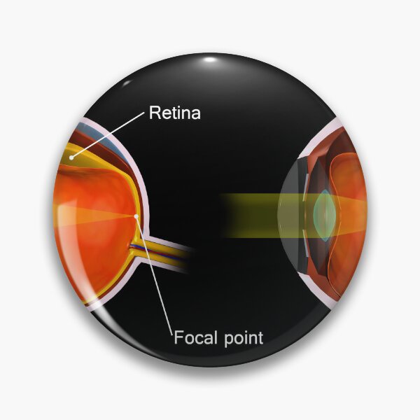 Item preview, STK701362H-A normal eye compared to an eye with myopia. designed and sold by StocktrekImages.