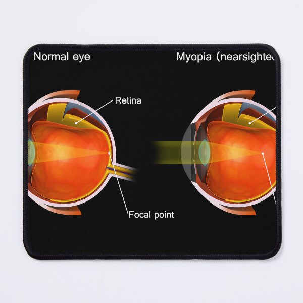 Item preview, STK701362H-A normal eye compared to an eye with myopia. designed and sold by StocktrekImages.