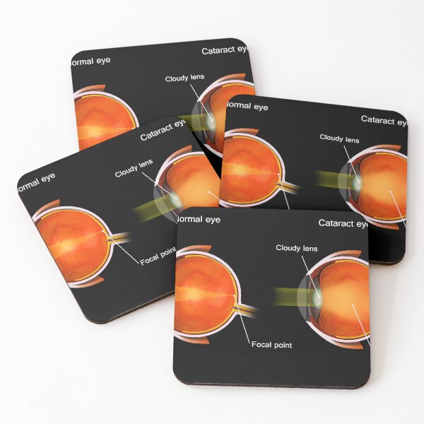 Item preview, STK701364H-Cataract in the human eye compared to a normal eye. designed and sold by StocktrekImages.