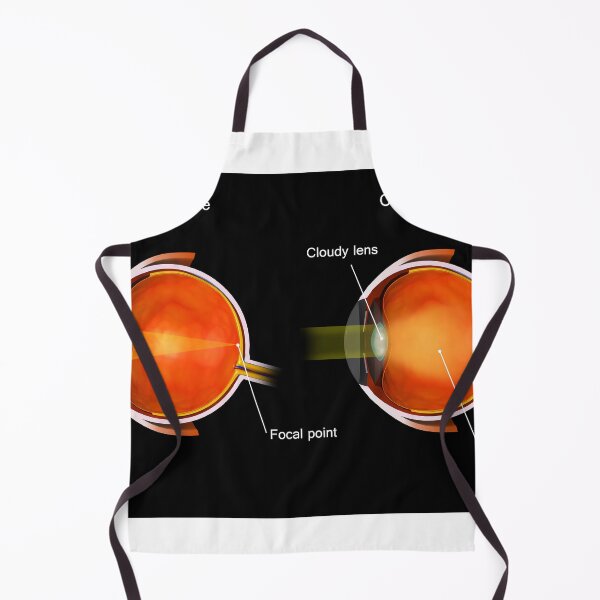 Item preview, STK701364H-Cataract in the human eye compared to a normal eye. designed and sold by StocktrekImages.