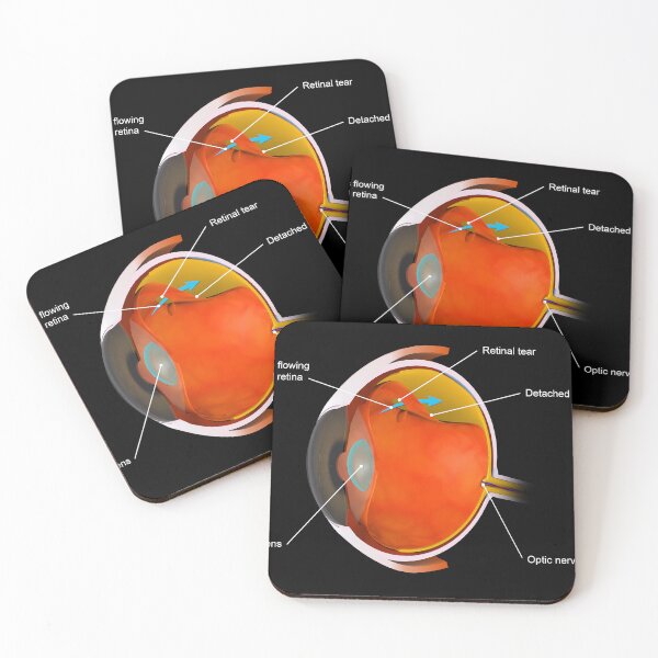 Item preview, STK701365H-A detached retina. designed and sold by StocktrekImages.
