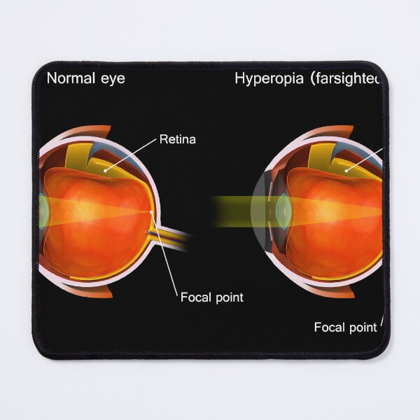 Item preview, STK701366H-Normal eye compared to an eye with hyperopia. designed and sold by StocktrekImages.