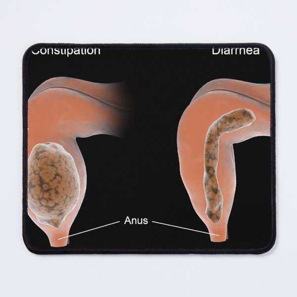 Item preview, STK701377H-Constipation vs. diarrhea designed and sold by StocktrekImages.