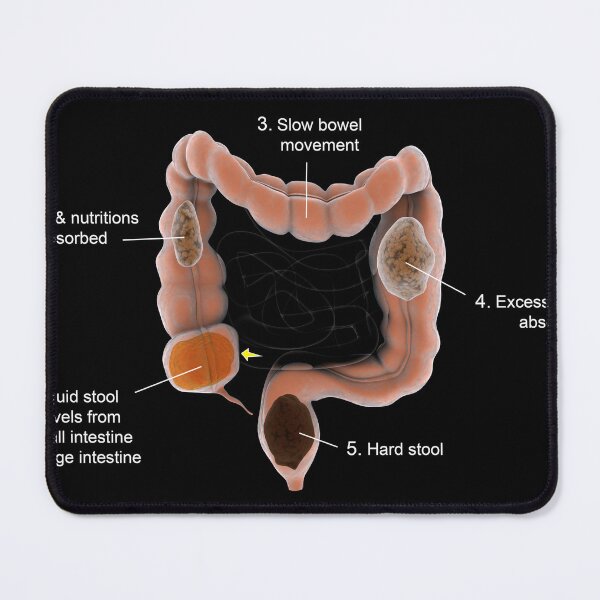 Item preview, STK701378H-Constipation in the human intestines. designed and sold by StocktrekImages.