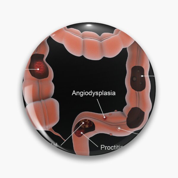 Item preview, STK701379H-Types of colon diseases. designed and sold by StocktrekImages.