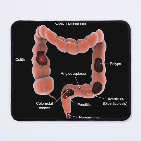 Item preview, STK701379H-Types of colon diseases. designed and sold by StocktrekImages.
