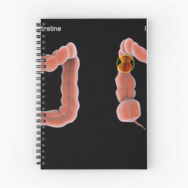 Item preview, STK701380H-Normal vs. abnormal bowel contractions. designed and sold by StocktrekImages.