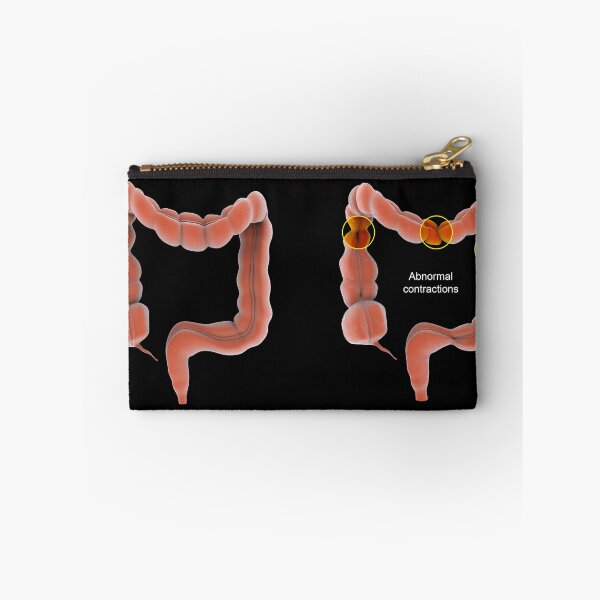 Item preview, STK701380H-Normal vs. abnormal bowel contractions. designed and sold by StocktrekImages.